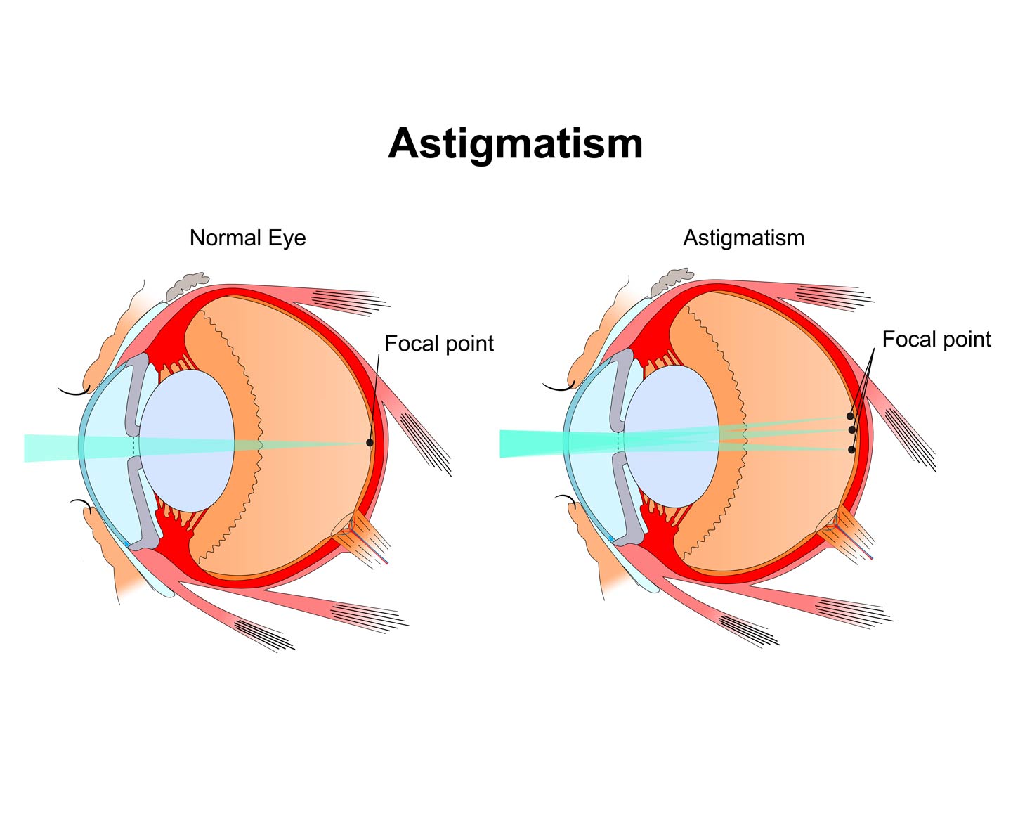 astigmatism congenital hipermetropie miopie pupile mari